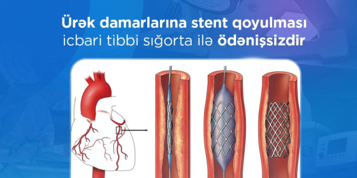 Ürək damarlarına stent qoyulması icbari tibbi sığorta ilə ödənişsizdir
